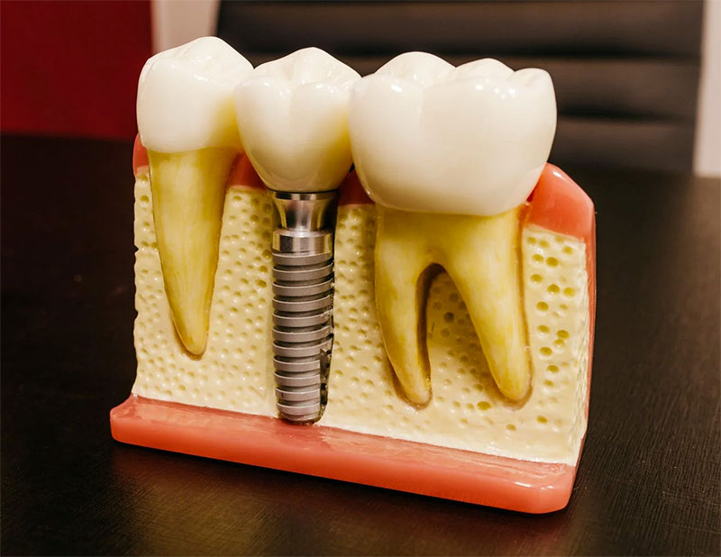 Implantes Dentários